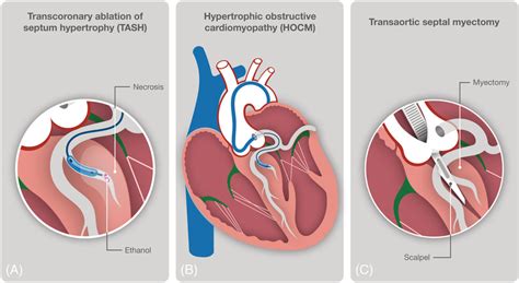 Percutaneous transluminal septal myocardial ablation 